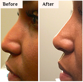 before and after nose reshape mamaroneck